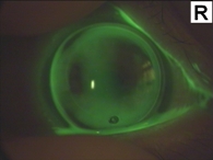 Keratoplastik-Speziallinse, die in allen vier Quadranten unterschiedliche Krümmungen hat