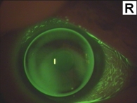 Speziallinse bei Keratokonus