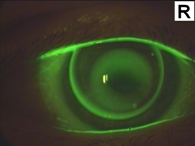 Speziallinse bei Keratokonus